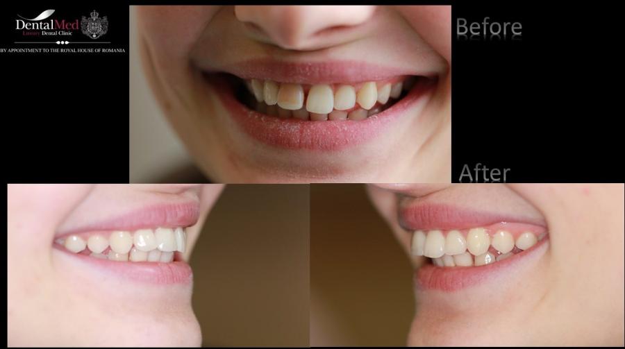 Galipa%20Alina%20fatete%20plansa%202 Estetica dentara si protetica - coroana si proteza dentara