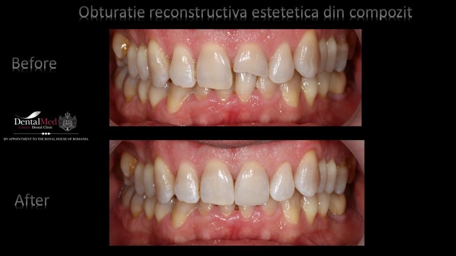Obturatii%20compozit%20Case%20Study%201%20picture%202 Protetica dentara si estetica dentara Bucuresti
