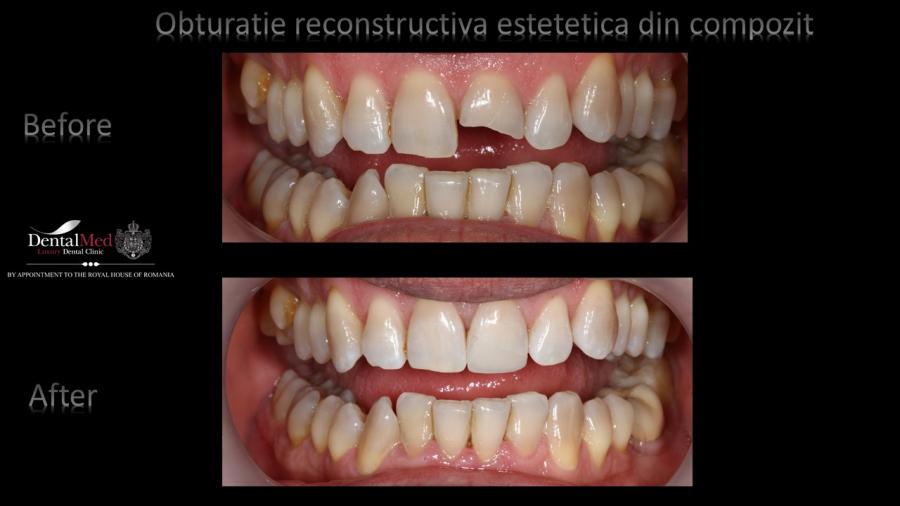 Obturatii%20compozit%20Case%20Study%201 Estetica dentara si protetica - coroana si proteza dentara