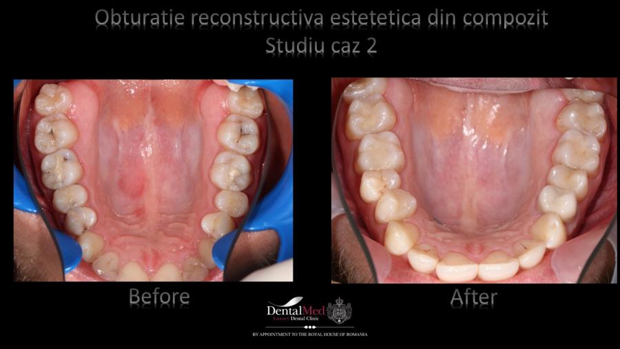 Obturatii%20compozit%20Case%20Study%202%20picture%202 Protetica dentara si estetica dentara Bucuresti