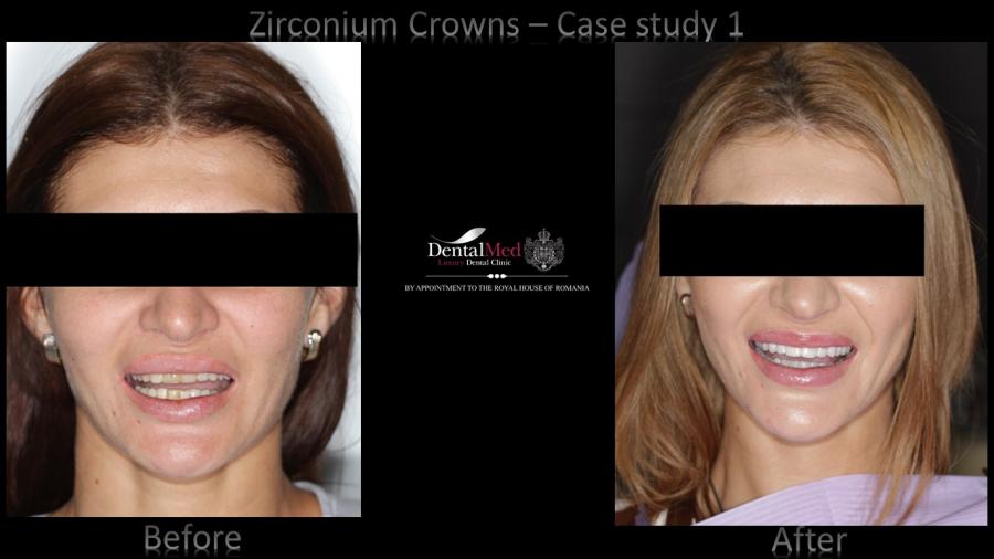 Zirconium%20Crowns%20case%201%20picture%201 Protetica dentara si estetica dentara Bucuresti