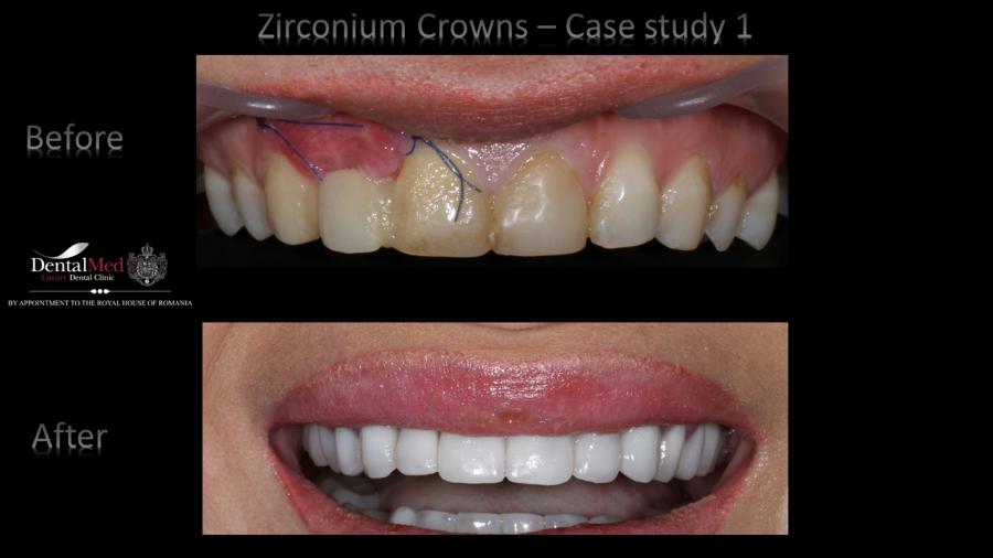 Zirconium%20Crowns%20case%201%20picture%203 Estetica dentara si protetica - coroana si proteza dentara