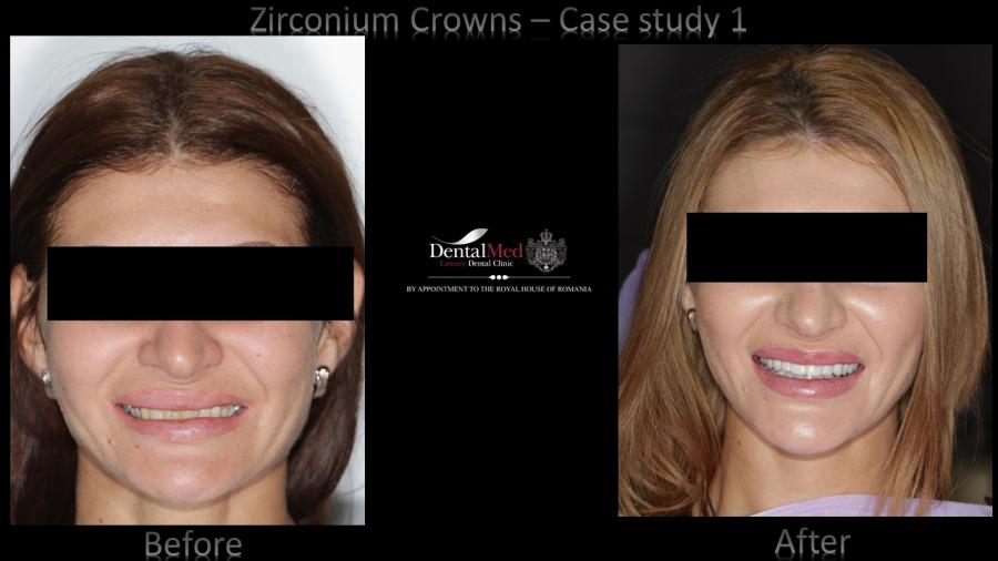 Zirconium%20Crowns%20case%201%20picture%204 Estetica dentara si protetica - coroana si proteza dentara